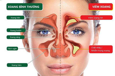 Viêm xoang là gì? Nguyên nhân gây bệnh viêm xoang