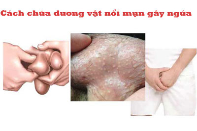 Cách chữa dương vật nổi mụn gây ngứa