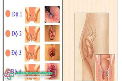 Bệnh trĩ là gì? Phân loại bệnh trĩ thường gặp