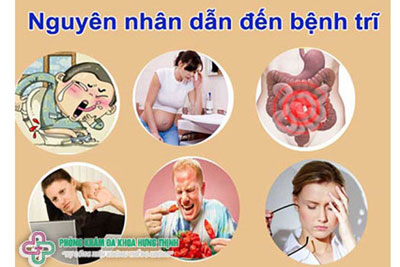Nguyên nhân bệnh trĩ