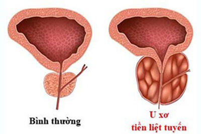 U xơ tiền liệt tuyến là bệnh gì? Nguyên nhân gây bệnh