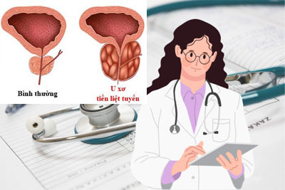 Cách chữa u xơ tiền liệt tuyến