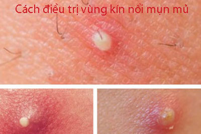 Cách điều trị vùng kín nổi mụn mủ