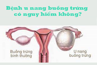 U nang buồng trứng có nguy hiểm không?
