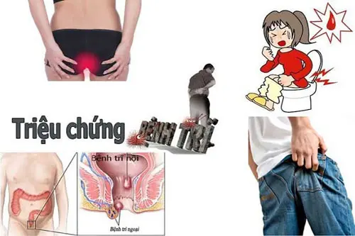 D?u hi?u tri?u ch?ng b?nh tri thu?ng g?p