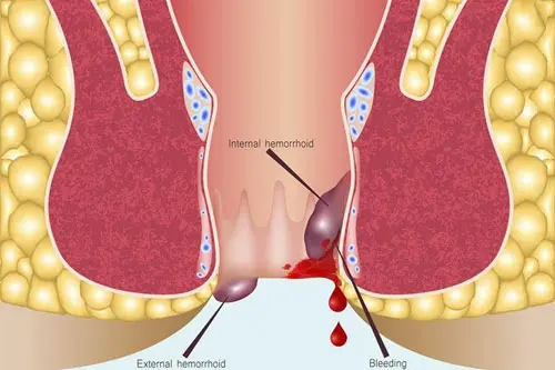 Xu?t hi?n mou dung trong byi tri