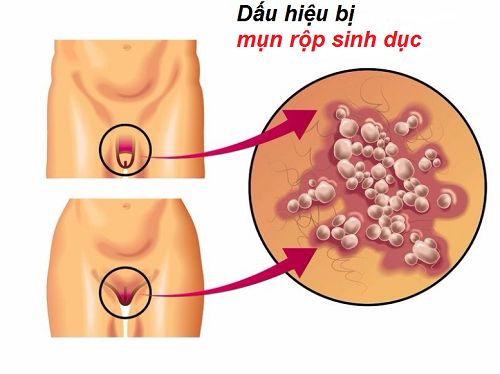 Cách chữa mụn rộp sinh dục tại nhà là gì