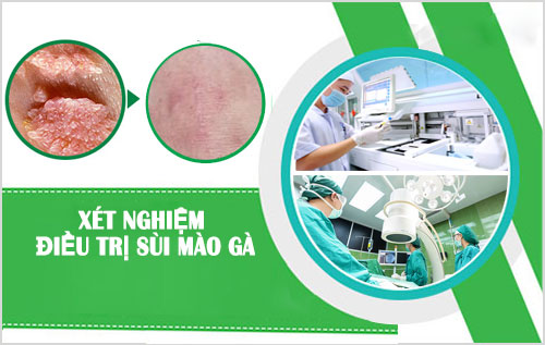 Cách điều trị sùi mào gà ở miệng bao gồm