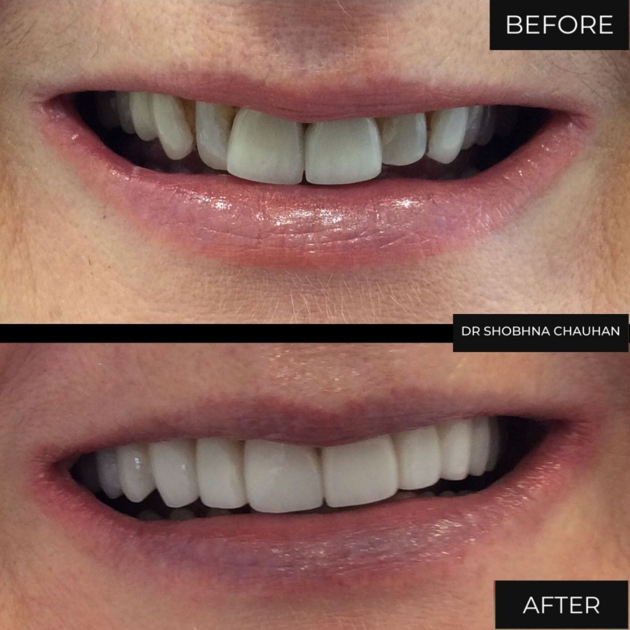 Dental Veneers Birmingham Porcelain Veneers