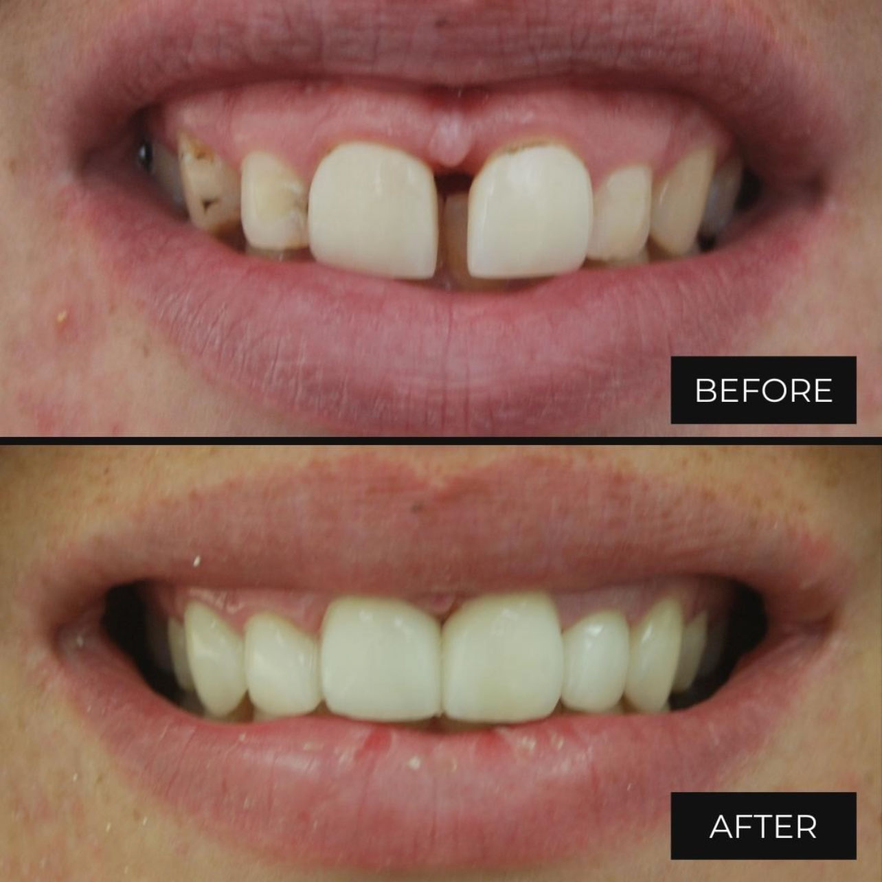 Porcelain Veneers Treatment Birmingham