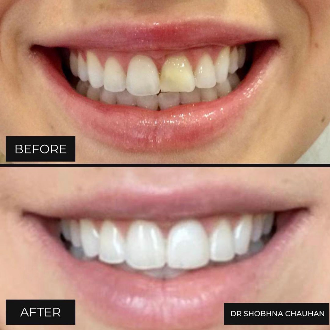 Dental Veneers Birmingham Porcelain Veneers