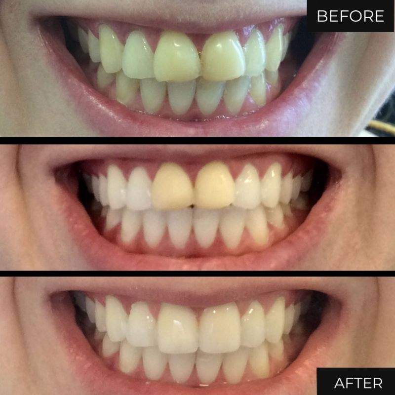 Dental Veneers Birmingham Porcelain Veneers