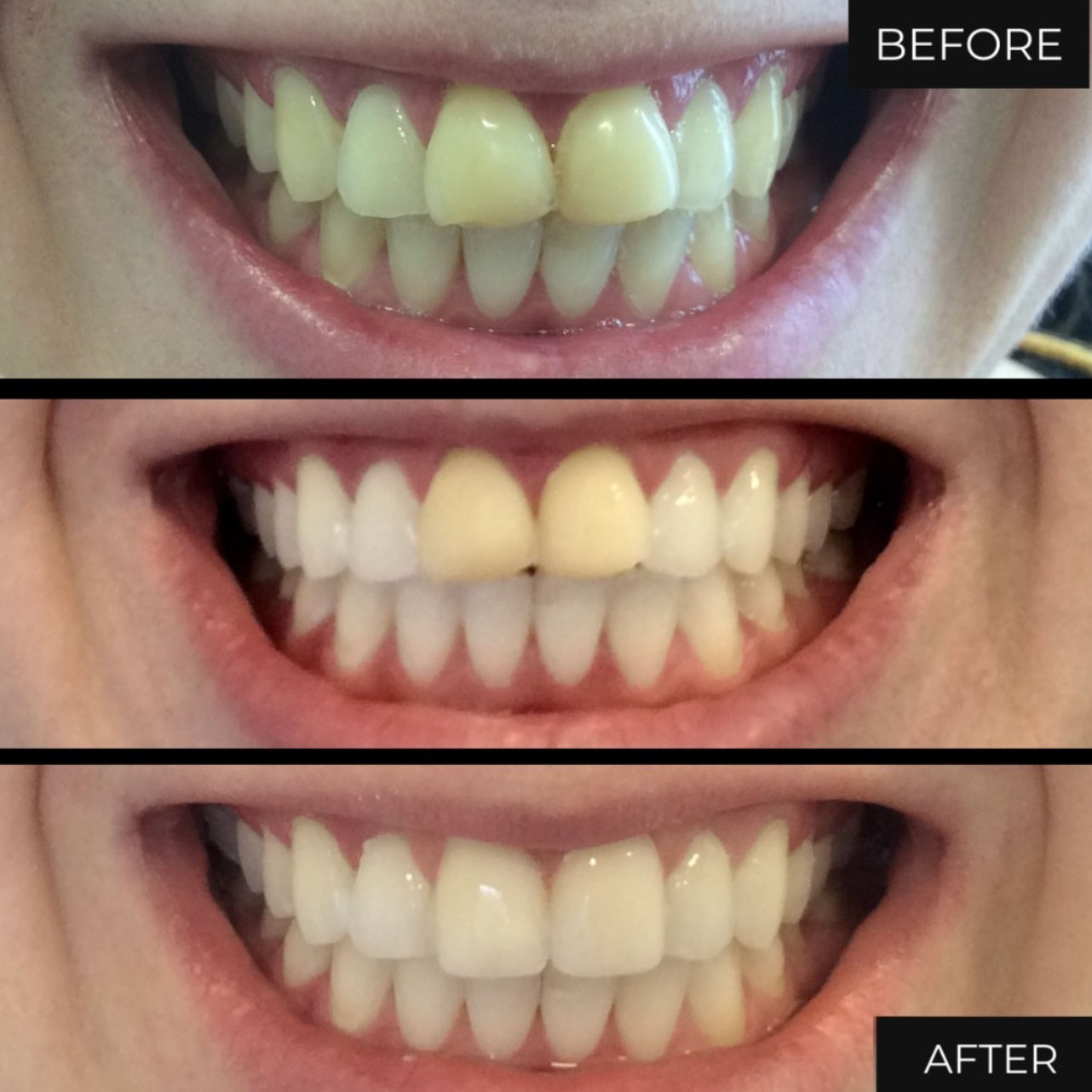 Dental Veneers Birmingham Porcelain Veneers