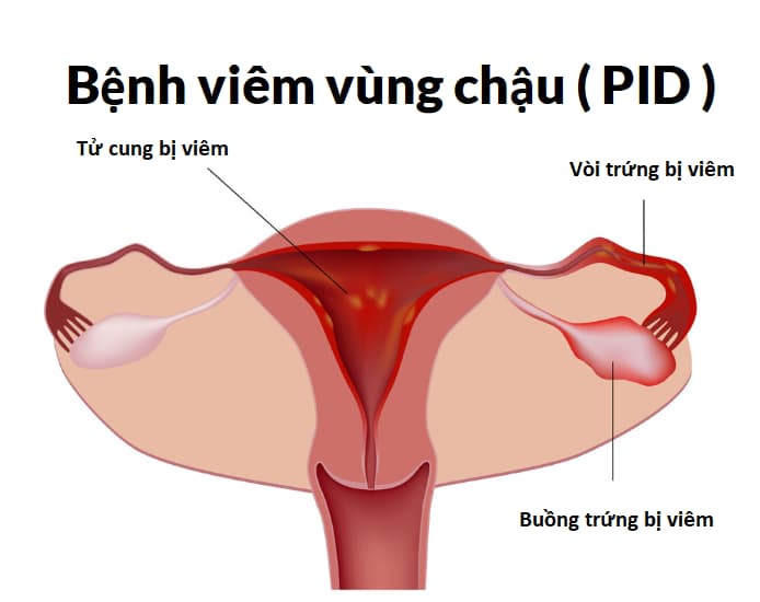Bệnh viêm vùng chậu là gì? Triệu chứng, nguyên nhân và điều trị