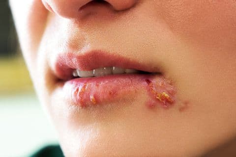 Bệnh giang mai ở nữ: Triệu chứng, dấu hiệu và điều trị