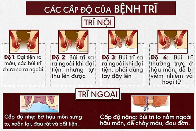 Bệnh trĩ là gì? Các triệu chứng, nguyên nhân và cách điều trị