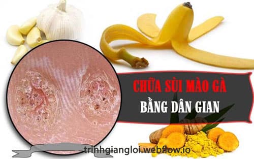 Điều trị sùi mào gà bằng phương pháp dân gian