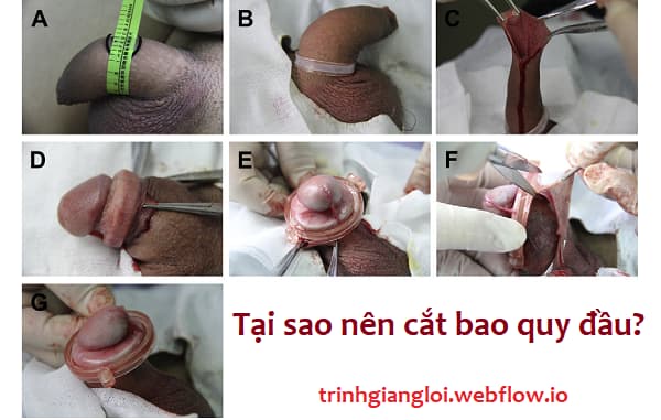 Tại sao phải cắt bao quy đầu?