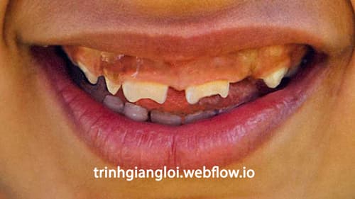 Dấu hiệu răng bất thường khi bị giang mai bẩm sinh muộn