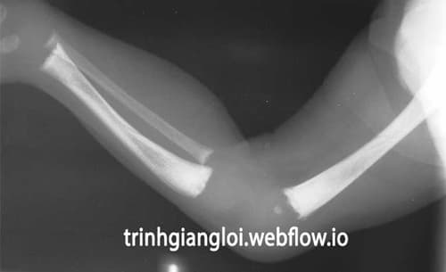 Xquang xương xét nghiệm có nhiễm giang mai không?