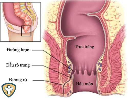 Khái quát sơ lược về bệnh rò hậu môn