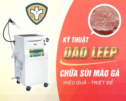 Cách chữa bệnh sùi mào gà hiệu quả bằng dao LEEP