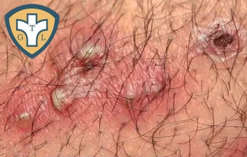 Cách điều trị bộ phận sinh dục nam nổi mụn