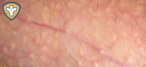Bộ phận sinh dục nam nổi mụn là bệnh gì?