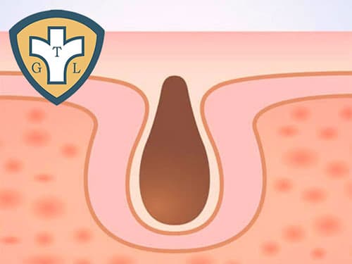 Mụn cóc sinh dục khiến dương vật nổi mụn cứng