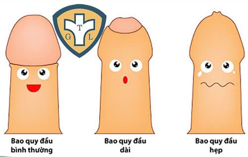 Hẹp bao quy đầu: Triệu chứng, nguyên nhân và cách điều trị