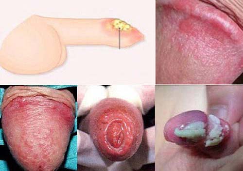 Lỗ sáo bị viêm loét do viêm quy đầu