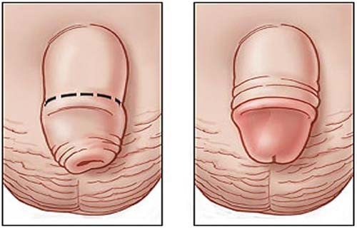 Địa chỉ cắt bao quy đầu uy tín ở Hà Nội