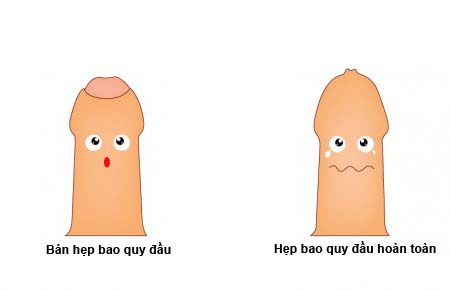 hẹp bao quy đầu là gì