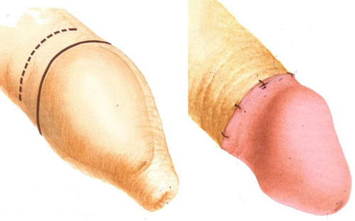 cách chữa hẹp bao quy đầu
