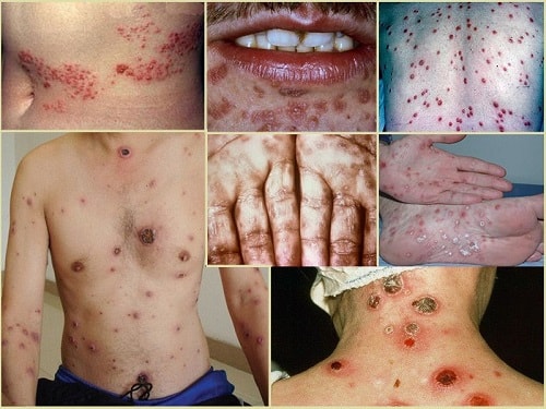 Bệnh giang mai là gì? Nguyên nhân, triệu chứng và cách điều trị