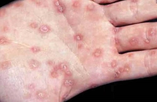 Bệnh giang mai là gì? Nguyên nhân, triệu chứng và cách điều trị