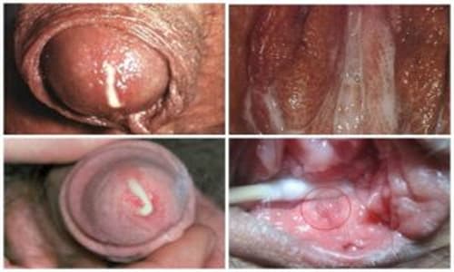 Bệnh lậu là gì? Biểu hiện, triệu chứng, cách điều trị bệnh lậu 3