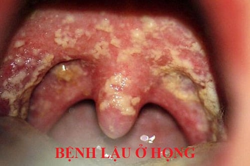 Bệnh lậu là gì? Biểu hiện, triệu chứng, cách điều trị bệnh lậu 1