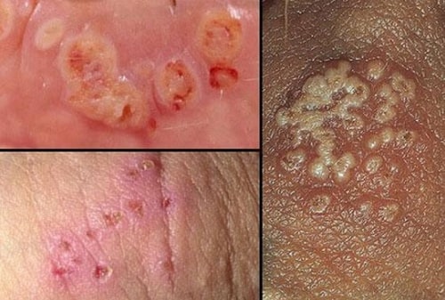 Bệnh lậu là gì? Biểu hiện, triệu chứng, cách điều trị bệnh lậu 5