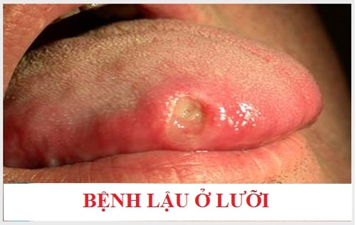 Bệnh lậu là gì? Biểu hiện, triệu chứng, cách điều trị bệnh lậu 2