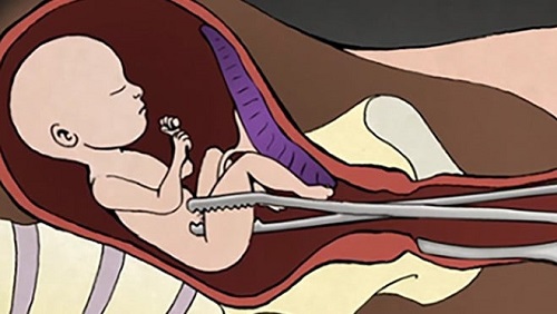 Chi phí nạo phá thai an toàn, không đau hết bao nhiêu tiền? 4