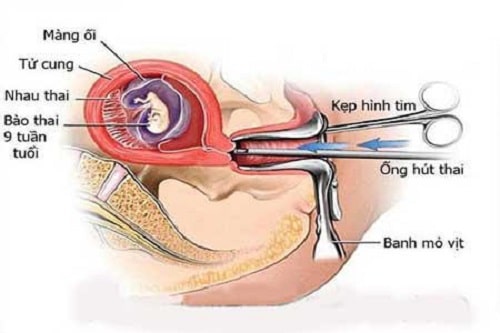 Hút thai an toàn là gì có đau không bao nhiêu tiền 1