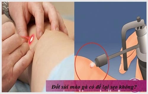 Chi phí chữa bệnh sùi mào gà khoảng bao nhiêu tiền? 6