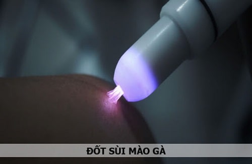 Chi phí chữa bệnh sùi mào gà khoảng bao nhiêu tiền? 7