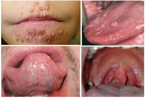 Mụn cóc là gì cách trị mụn cóc ở tay chân tại nhà nhanh khỏi nhất 8