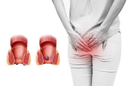 10 Địa chỉ chữa bệnh trĩ ở đâu tốt nhất an toàn tại Hà Nội