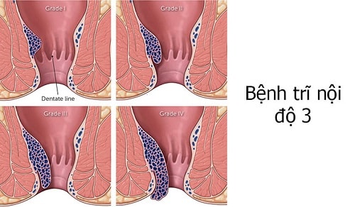 10 Địa chỉ chữa bệnh trĩ ở đâu tốt nhất an toàn tại Hà Nội 2