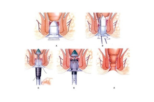 10 Địa chỉ chữa bệnh trĩ ở đâu tốt nhất an toàn tại Hà Nội 9