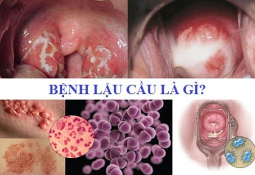 Khám chữa bệnh lậu ở đâu tốt nhất Hà Nội top 10 địa chỉ uy tín