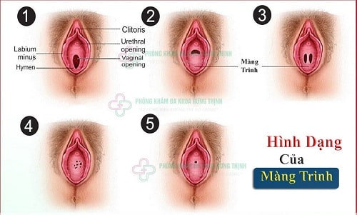 Vá màng trinh là gì giá vá màng trinh hết bao nhiêu tiền